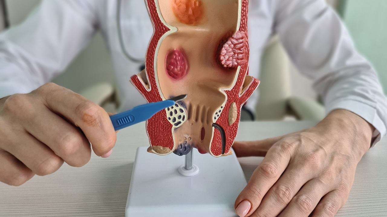emorroidectomia